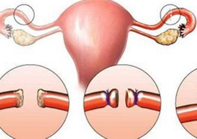 女性输卵管结扎过程图片